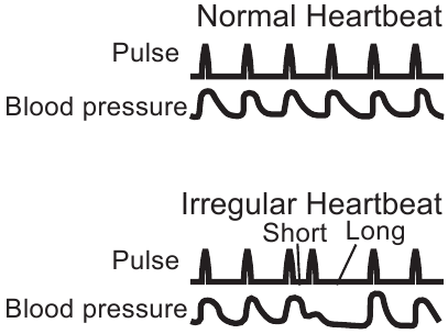OMRON - RS3 Intelli IT - Символ нерегулярного сердцебиения Символ нерегулярного сердцебиения