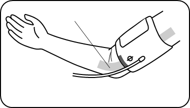 PRIMJENA MANŽETE - 3. korak