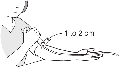 Bilak manjetini qo'llash - 2-qadam
